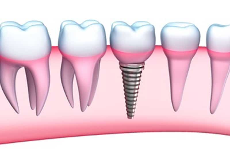 Dental implant Dentist in Denver