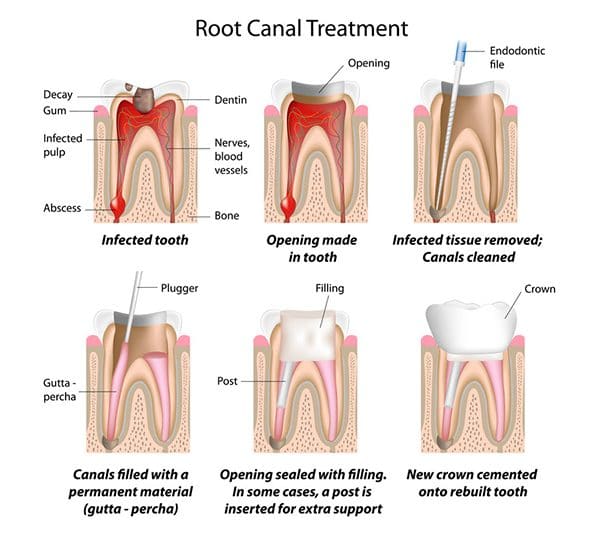what is a root canal