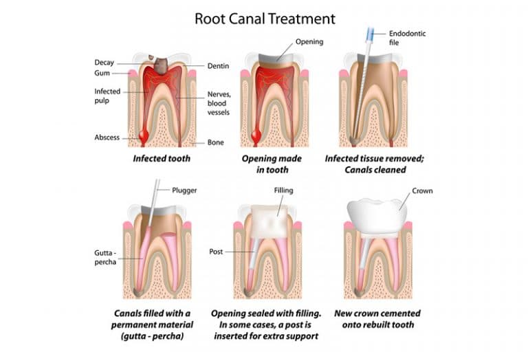what is a root canal