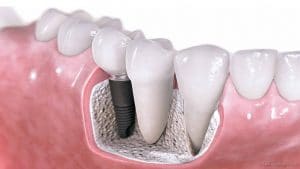 Some Amazing Benefits of Dental Implants